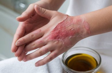 Huile de Tamanu et psoriasis